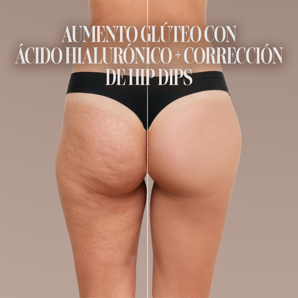 Buttock Augmentation with Hyaluronic Acid + Hip Dip Correction