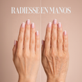 Radiesse en Manos