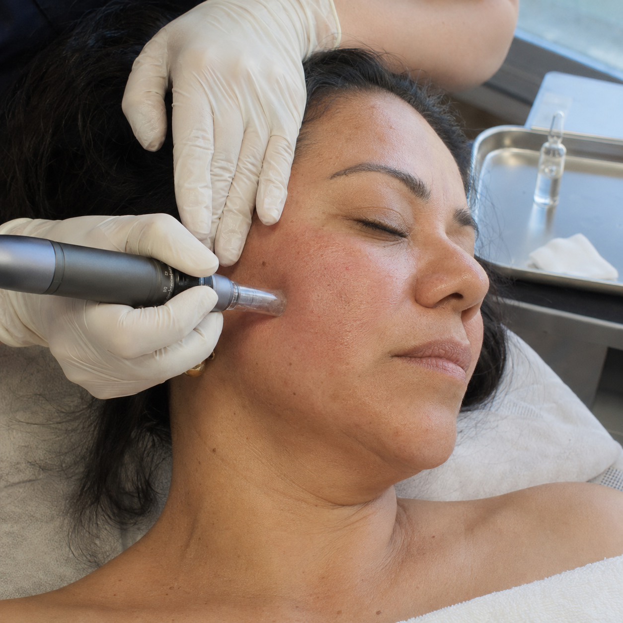 Microneedling facial + ámpula de vitaminas